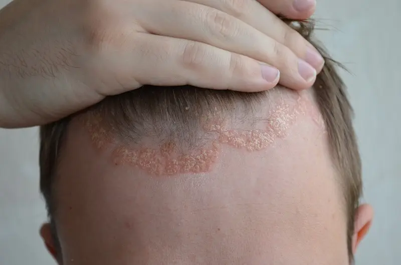 Psoriasis en el Cuero Cabelludo: Síntomas, Causas y Factores de Riesgo - Cómo saber si es psoriasis o no sintomas psoriasis en el cuero cabelludo - Cómo saber si es psoriasis o no
