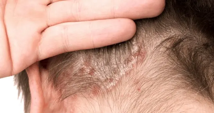 psoriasis cuero cabelludo en ninos - Cómo saber si un niño tiene psoriasis
