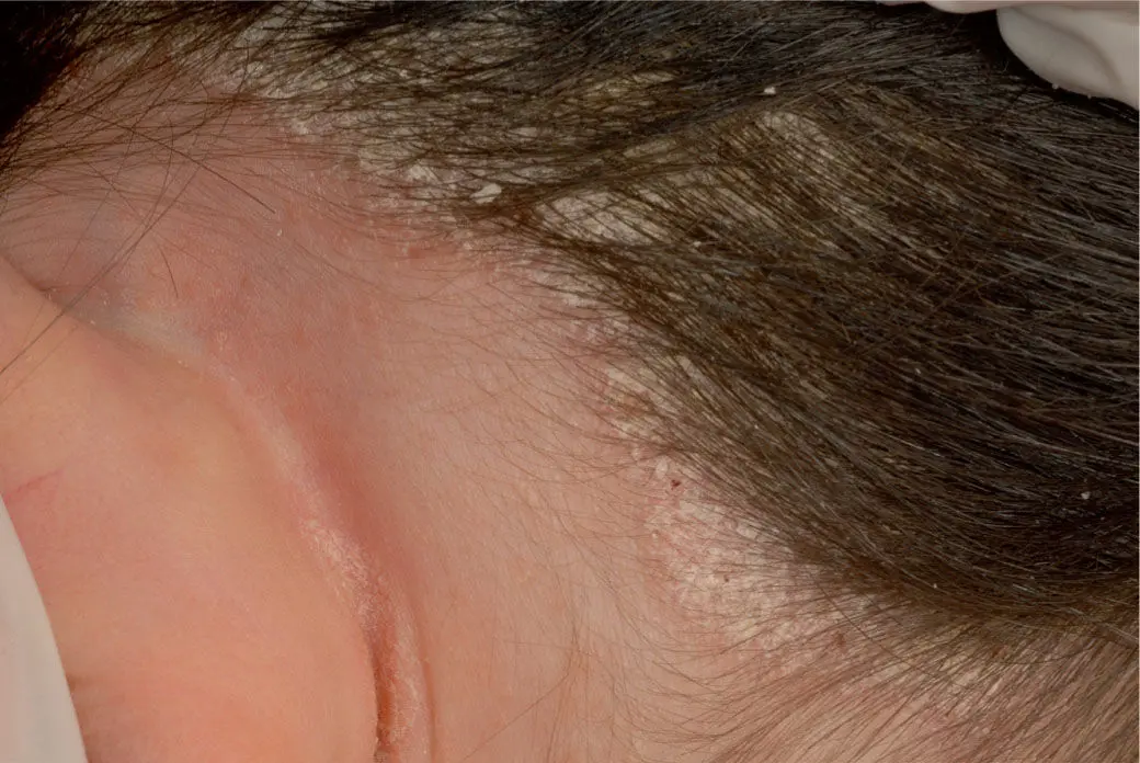 psoriasis cuero cabelludo en ninos - Cómo se cura la psoriasis en niños