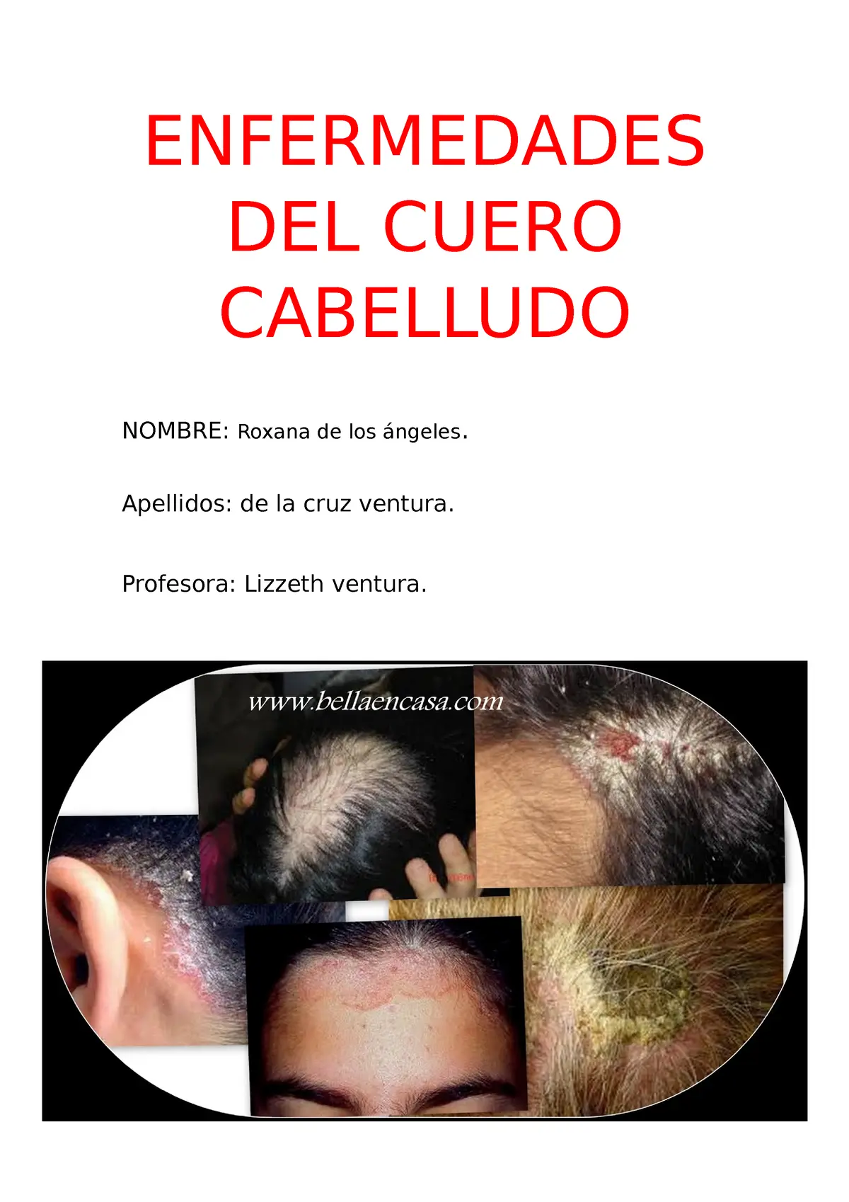 Enfermedades del Cuero Cabelludo: Guía Completa de Causas, Síntomas y Tratamientos - Cómo se llama la bacteria del cuero cabelludo lista de enfermedades del cuero cabelludo - Cómo se llama la bacteria del cuero cabelludo