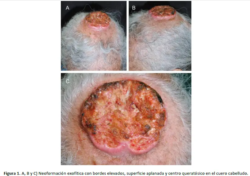 Carcinoma Basocelular en el Cuero Cabelludo: Un Desafío Terapéutico y Reconstructivo - Cómo se manifiesta el cáncer de piel en el cuero cabelludo carcinoma basocelular cuero cabelludo - Cómo se manifiesta el cáncer de piel en el cuero cabelludo
