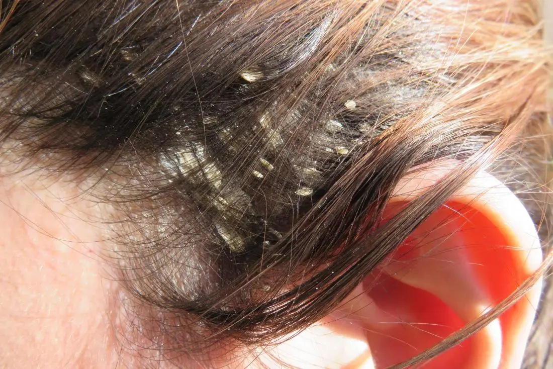 Neurodermatitis en el Cuero Cabelludo: Causas, Síntomas y Tratamiento - Cómo se ve la neurodermatitis neurodermatitis cuero cabelludo - Cómo se ve la neurodermatitis