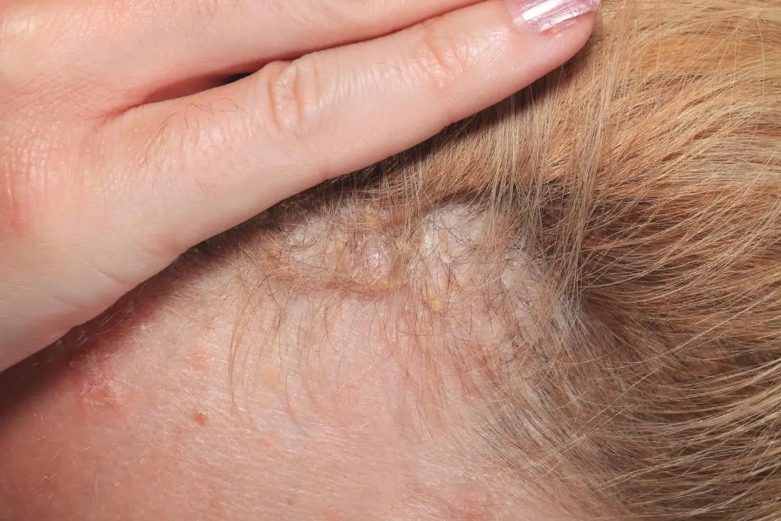 psoriasis cuero cabelludo en ninos - Cómo tratar la psoriasis en el cuero cabelludo de un niño