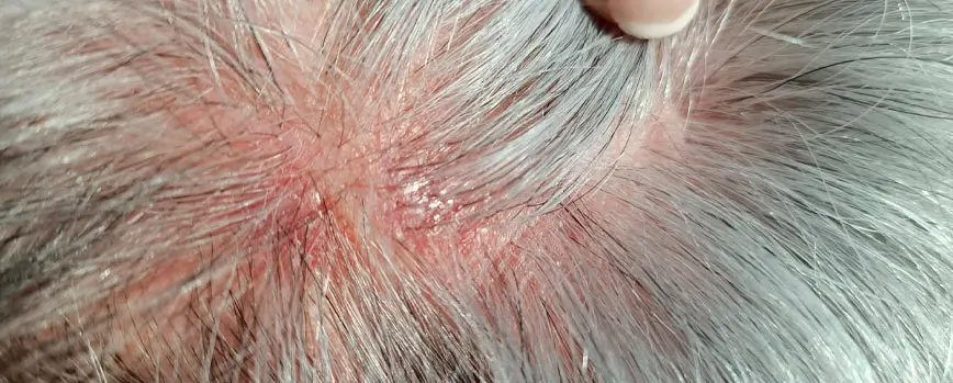 Dolor de Cuero Cabelludo: Causas, Tratamientos y Remedios Caseros - Por qué me duele el cráneo de la cabeza dolor cuero cabelludo tratamiento - Por qué me duele el cráneo de la cabeza