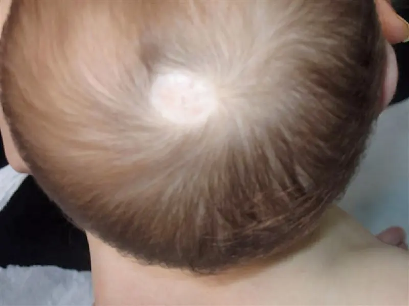 Aplasia Cutis del Cuero Cabelludo: Causas, Síntomas y Tratamiento - Qué causa la aplasia cutis aplasia cutis cuero cabelludo - Qué causa la aplasia cutis