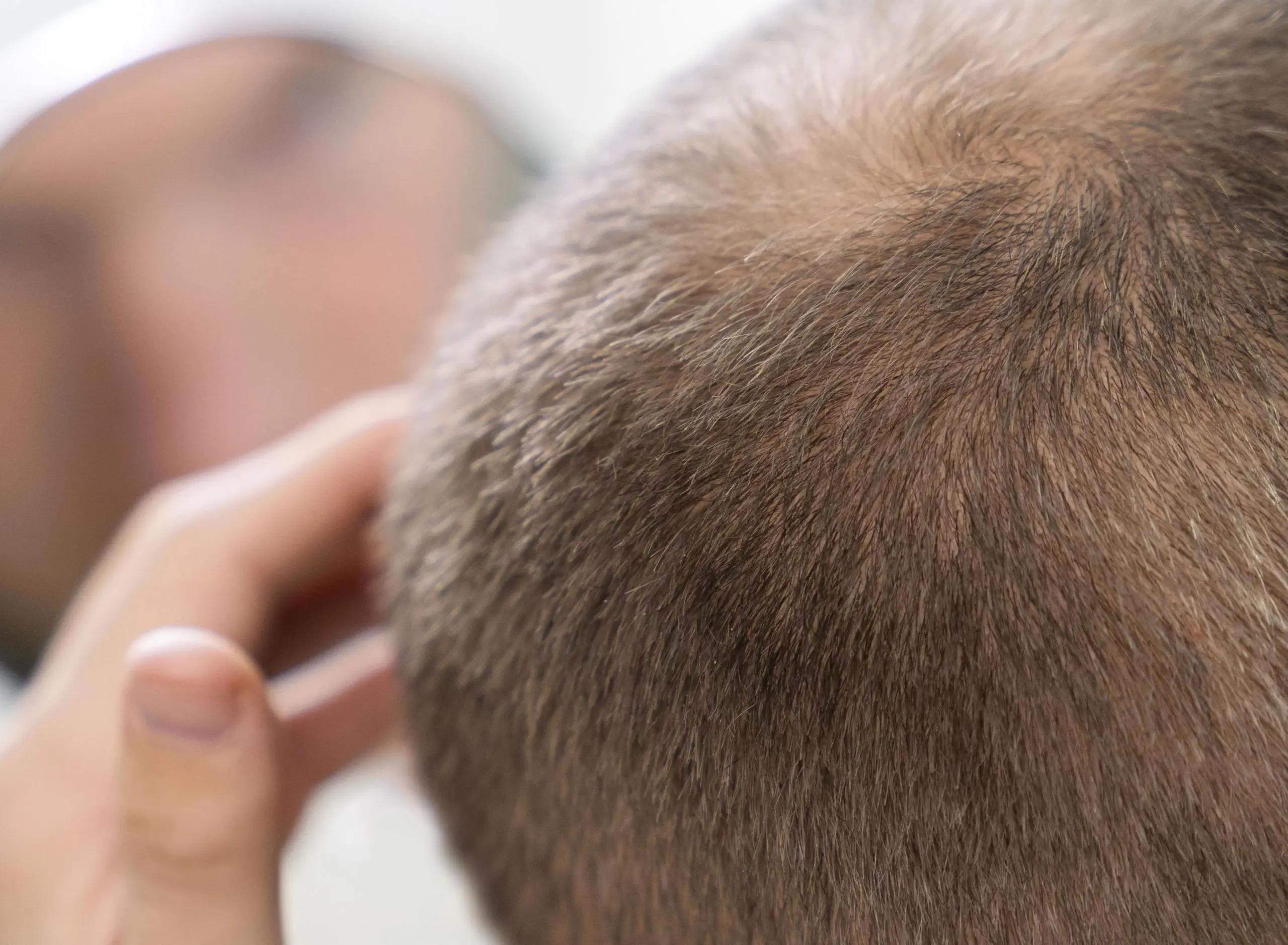 Dolor de Cuero Cabelludo: Causas, Tratamientos y Remedios Caseros - Qué es bueno para el dolor en el cuero cabelludo dolor cuero cabelludo tratamiento - Qué es bueno para el dolor en el cuero cabelludo