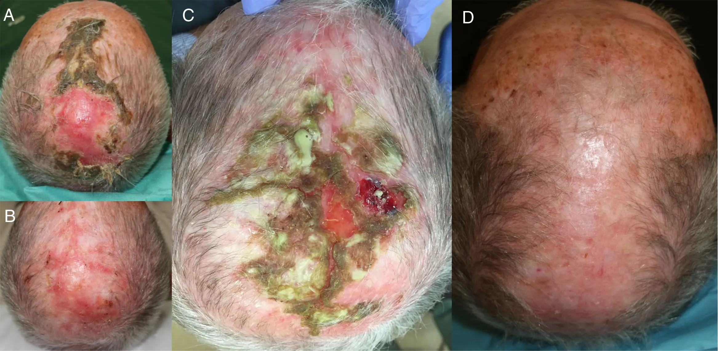 Dermatosis Erosiva Pustulosa del Cuero Cabelludo: Una Afección Poco Común - Qué es la dermatosis pustulosa dermatosis erosiva pustulosa del cuero cabelludo - Qué es la dermatosis pustulosa