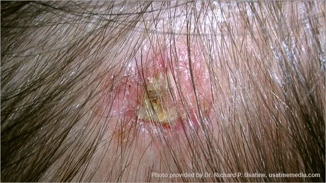 Carcinoma Basocelular en el Cuero Cabelludo: Un Desafío Terapéutico y Reconstructivo - Qué es un carcinoma en el cuero cabelludo carcinoma basocelular cuero cabelludo - Qué es un carcinoma en el cuero cabelludo