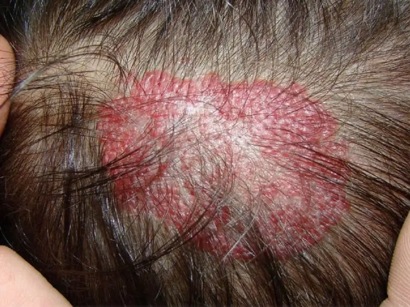 circulo rojo en el cuero cabelludo - Qué significa un punto rojo en el cuero cabelludo