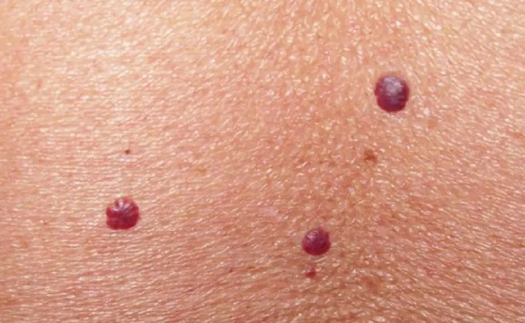 puntos rojos en el cuero cabelludo - Qué son las bolitas rojas que salen en la cabeza
