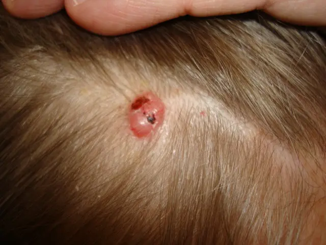 Carcinoma Basocelular en el Cuero Cabelludo: Un Desafío Terapéutico y Reconstructivo - Qué tan agresivo es el carcinoma basocelular carcinoma basocelular cuero cabelludo - Qué tan agresivo es el carcinoma basocelular